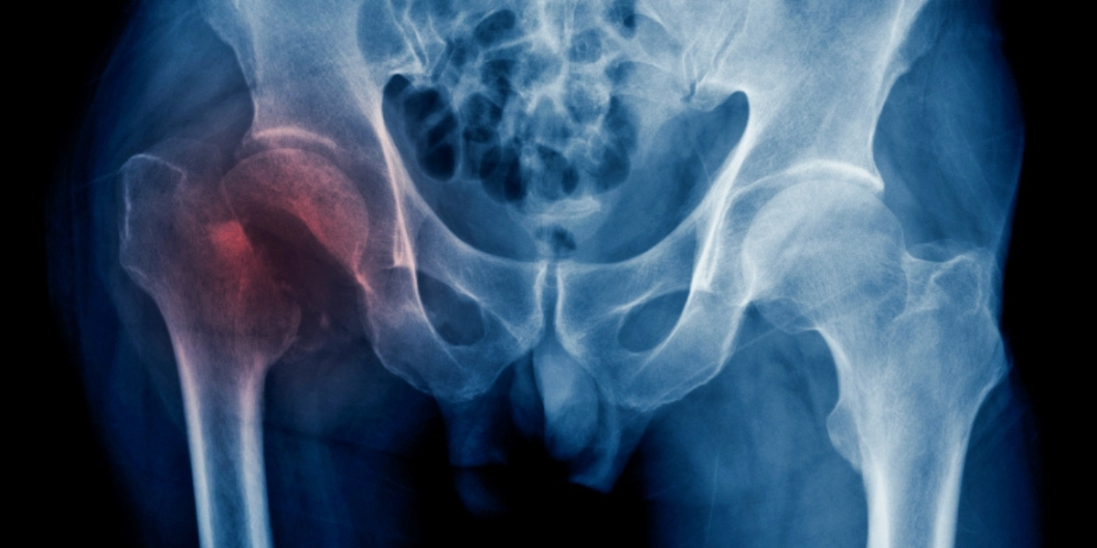 what to do with hip fractures on older adults